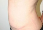 Tummy Tuck (Abdominoplasty)