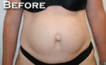 Tummy Tuck (Abdominoplasty)