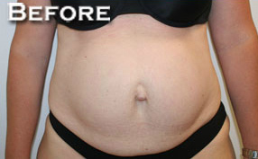 Tummy Tuck (Abdominoplasty)