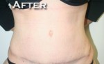 Tummy Tuck (Abdominoplasty)