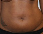 Tummy Tuck (Abdominoplasty)