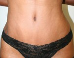 Tummy Tuck (Abdominoplasty)