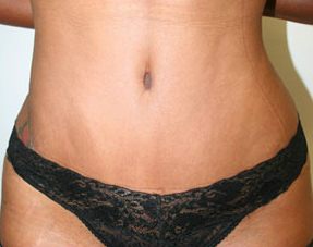 Tummy Tuck (Abdominoplasty)