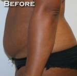 Tummy Tuck (Abdominoplasty)