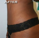 Tummy Tuck (Abdominoplasty)