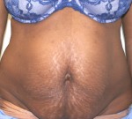 Tummy Tuck (Abdominoplasty)