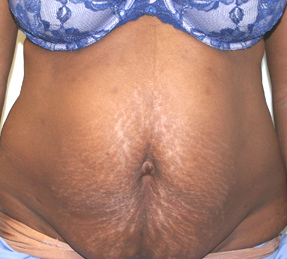 Tummy Tuck (Abdominoplasty)