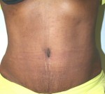 Tummy Tuck (Abdominoplasty)