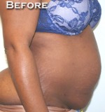 Tummy Tuck (Abdominoplasty)