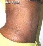 Tummy Tuck (Abdominoplasty)