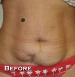 Tummy Tuck (Abdominoplasty)