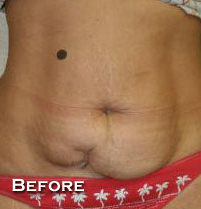 Tummy Tuck (Abdominoplasty)
