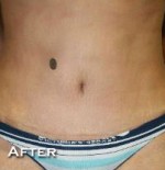 Tummy Tuck (Abdominoplasty)