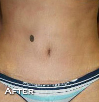 Tummy Tuck (Abdominoplasty)