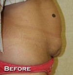 Tummy Tuck (Abdominoplasty)