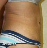 Tummy Tuck (Abdominoplasty)
