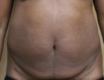 Tummy Tuck (Abdominoplasty)