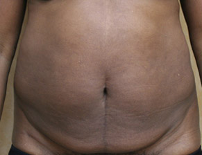 Tummy Tuck (Abdominoplasty)