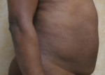 Tummy Tuck (Abdominoplasty)