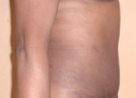 Tummy Tuck (Abdominoplasty)