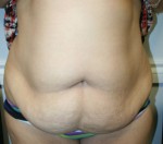 Tummy Tuck (Abdominoplasty)