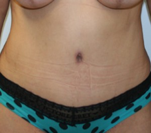 Tummy Tuck (Abdominoplasty)