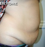 Tummy Tuck (Abdominoplasty)