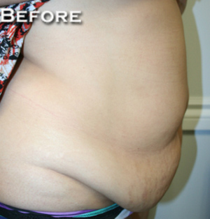 Tummy Tuck (Abdominoplasty)