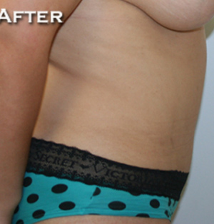 Tummy Tuck (Abdominoplasty)