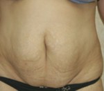 Tummy Tuck (Abdominoplasty)