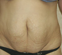 Tummy Tuck (Abdominoplasty)