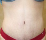 Tummy Tuck (Abdominoplasty)
