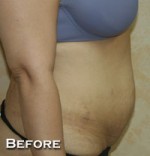 Tummy Tuck (Abdominoplasty)
