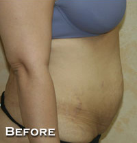 Tummy Tuck (Abdominoplasty)