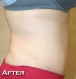 Tummy Tuck (Abdominoplasty)