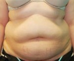 Tummy Tuck (Abdominoplasty)