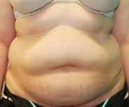 Tummy Tuck (Abdominoplasty)