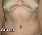 Tummy Tuck (Abdominoplasty)