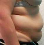 Tummy Tuck (Abdominoplasty)