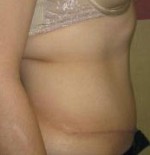 Tummy Tuck (Abdominoplasty)