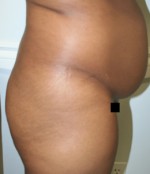 Tummy Tuck (Abdominoplasty)