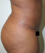 Tummy Tuck (Abdominoplasty)