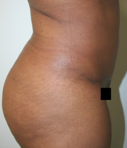 Tummy Tuck (Abdominoplasty)
