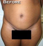 Tummy Tuck (Abdominoplasty)