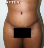 Tummy Tuck (Abdominoplasty)