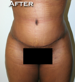 Tummy Tuck (Abdominoplasty)