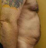 Tummy Tuck (Abdominoplasty)