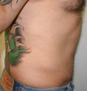 Tummy Tuck (Abdominoplasty)