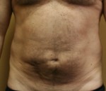Tummy Tuck (Abdominoplasty)