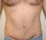 Tummy Tuck (Abdominoplasty)